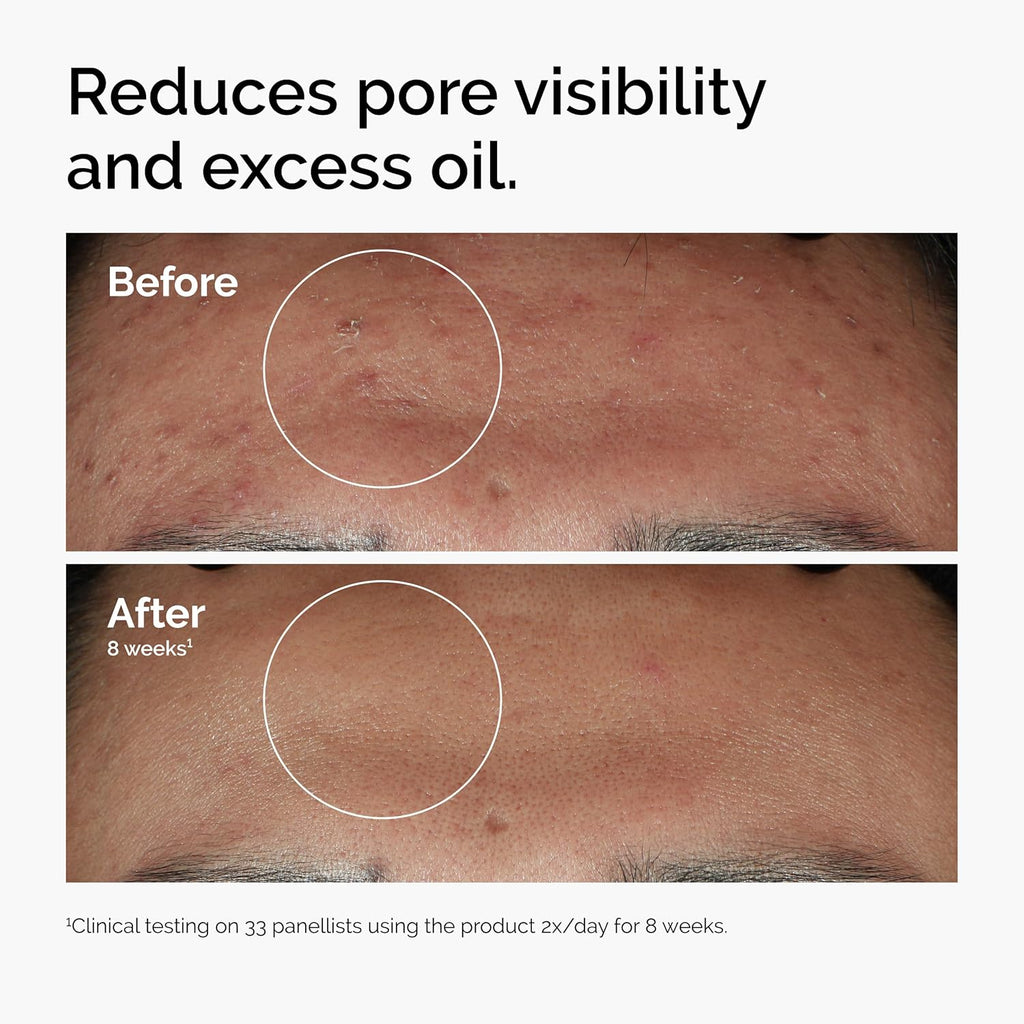 The Ordinary Niacinamide 10% + Zinc 1% Serum - photo 6