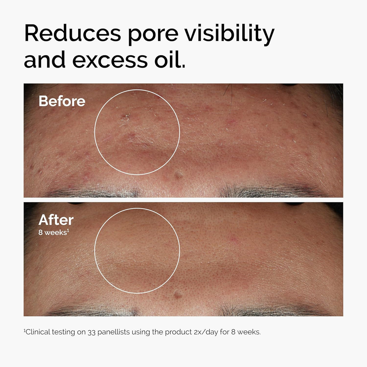 The Ordinary Niacinamide 10% + Zinc 1% Serum - photo 6